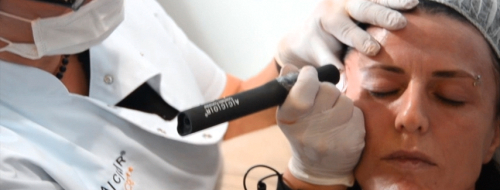Hautstraffung mit dem Accor Plasma Pen Hautstraffung mit dem Accor Plasma Pen